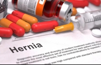 The Complete Guide To What’s Causing Your Hernia